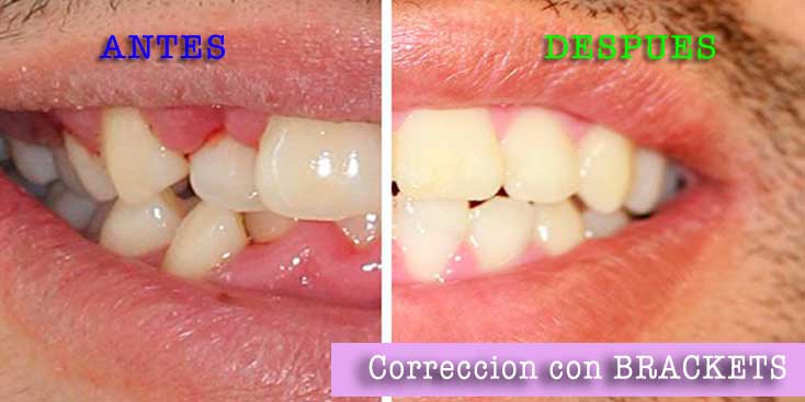 ORTODONCIA con BRACKETS