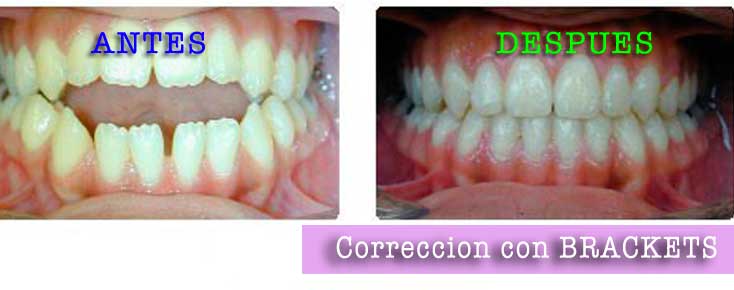 BRACKETS ORTODONCIA