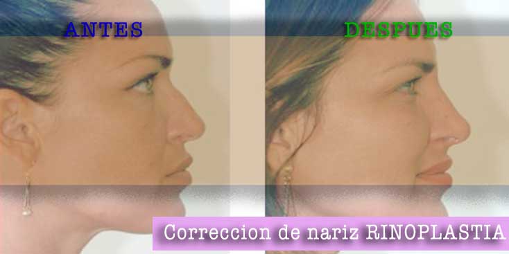 RINOPLASTIA antes despues