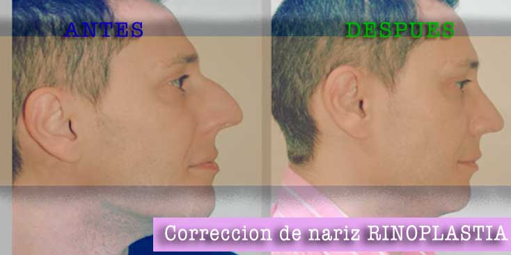 RINOPLASTIA