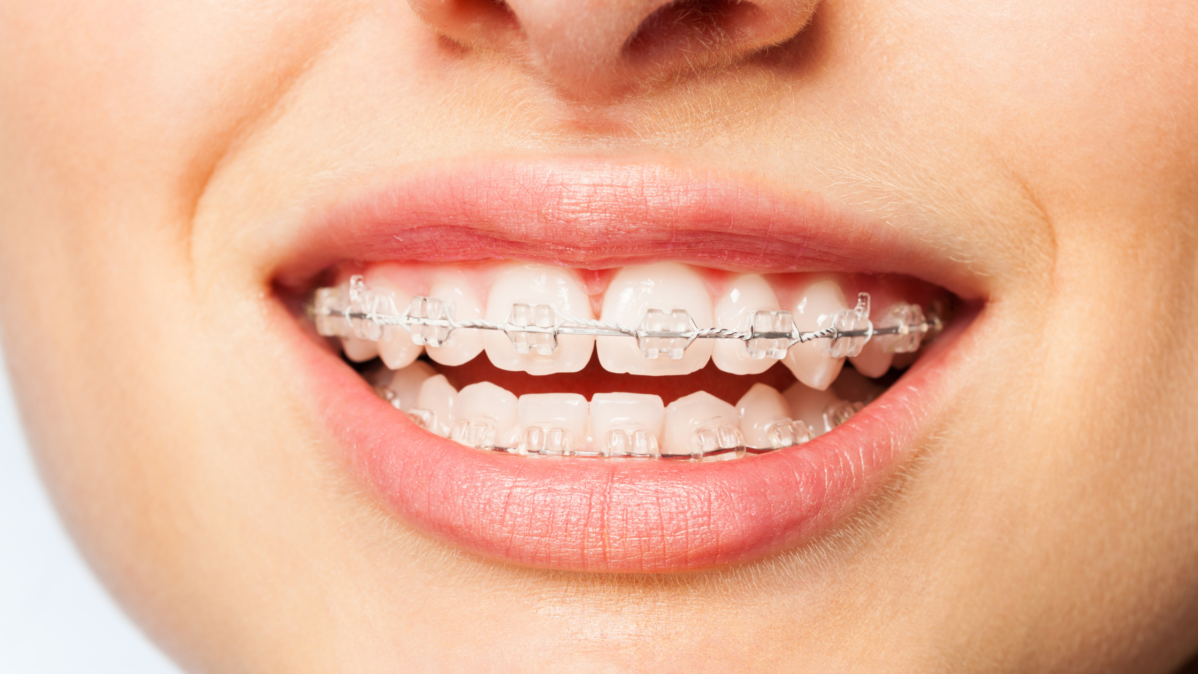 brackets-esteticos